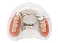 精密義歯（白金加金クラスプ使用）