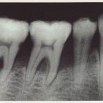 歯周病かどうかを調べるには？