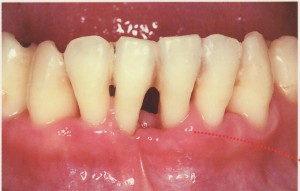 私の歯周病はよくなるの？