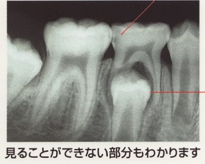 レントゲン撮影は、なぜ必要？