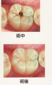 むし歯の進行