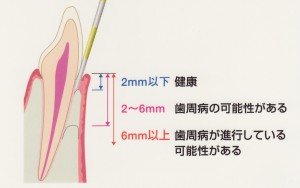 歯周ポケット検査って、なに？