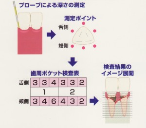 歯周ポケット検査って、なに？