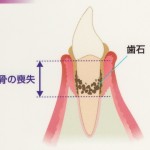 歯周病はどのように進行するの？