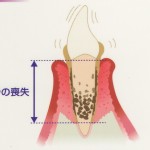 歯周病はどのように進行するの？