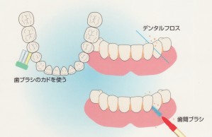 むし歯を防ぐにはどうしたらいいの？