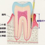 歯周病を進行させないためには？