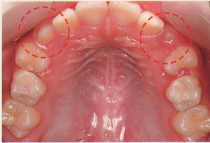 歯並びが悪くならないためには？