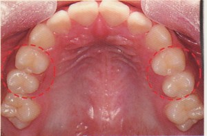 歯並びが悪くならないためには？