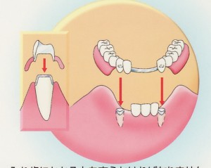 義歯を入れた後も定期健診？