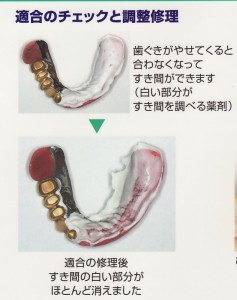 義歯を入れた後も定期健診？