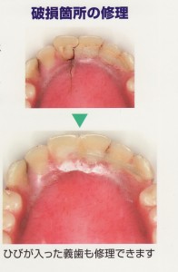 義歯を入れた後も定期健診？