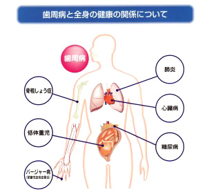 歯周病が全身にあたえる影響